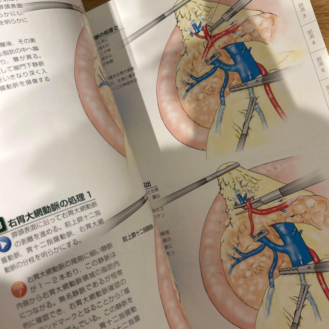 腹腔鏡下胃切除術 癌研スタイル