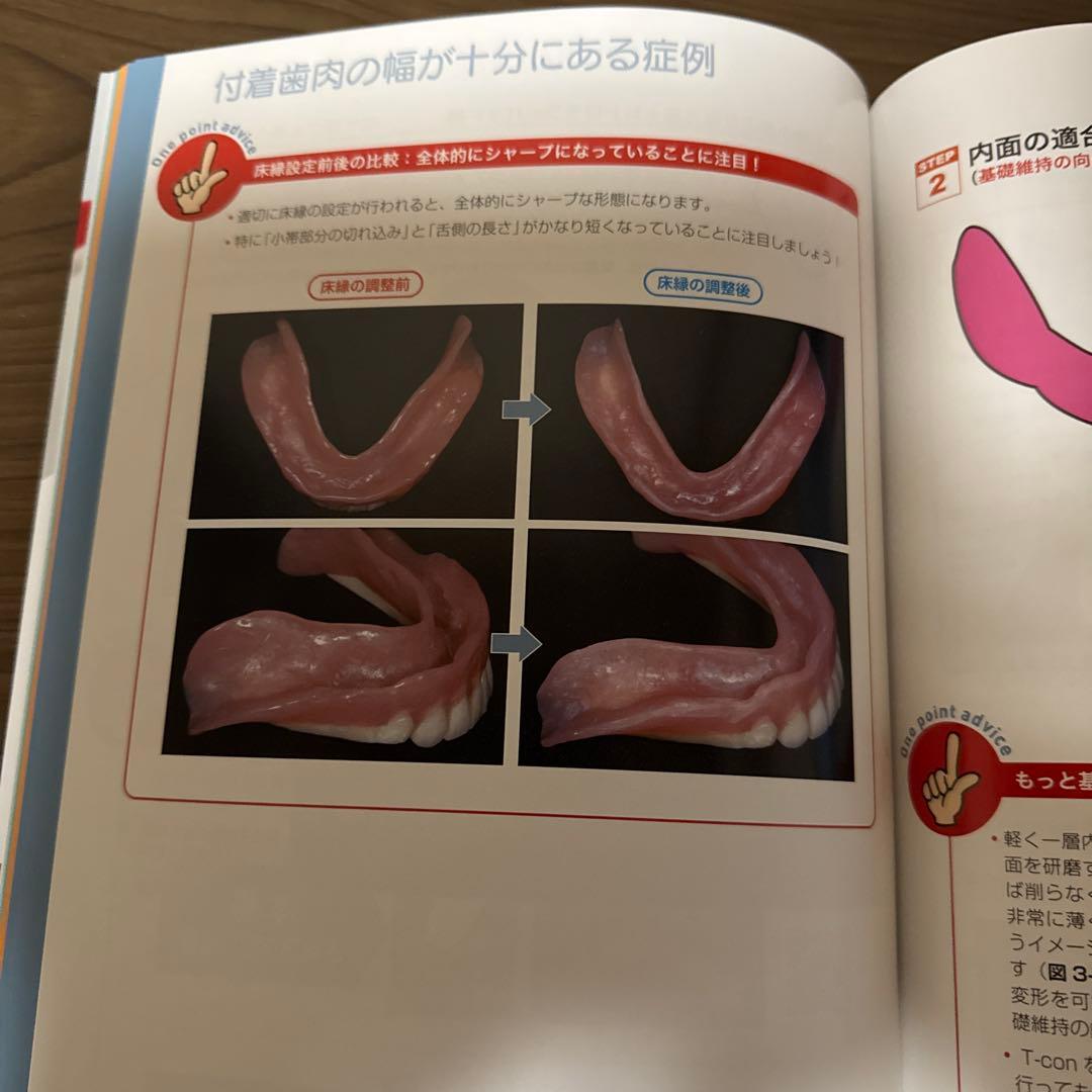H H H　患者さんが総義歯を使いこなすためのトレーニング法と義歯調整法