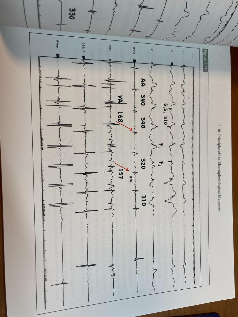 健康・医学 Electrophysiological Maneuvers