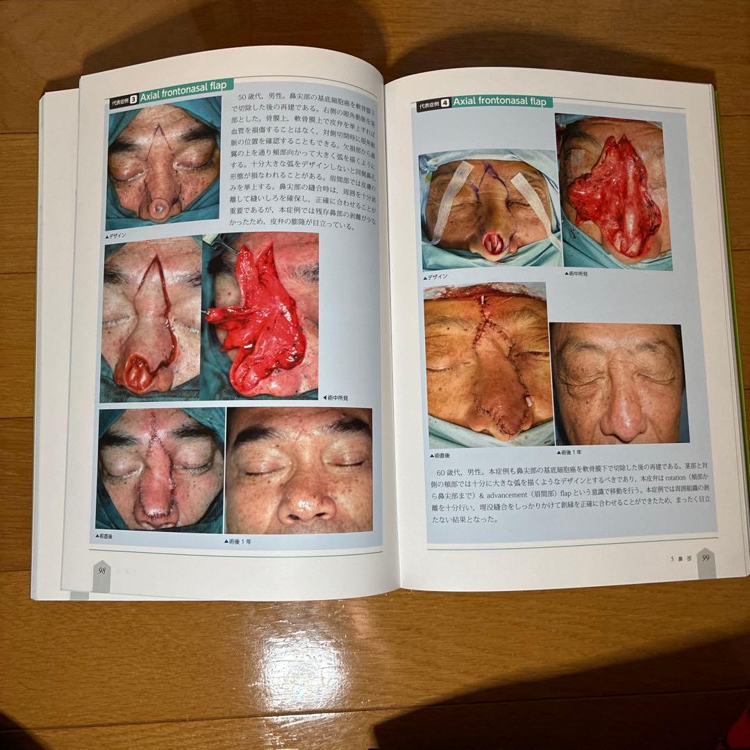 【値下げ中‼️】局所皮弁 1, 2, 3 セット