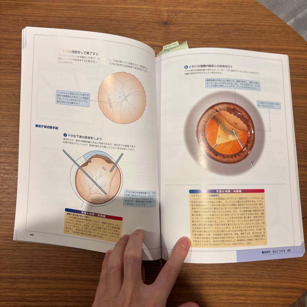 眼科　ES NOW 4 網膜剥離 こうすれば治る