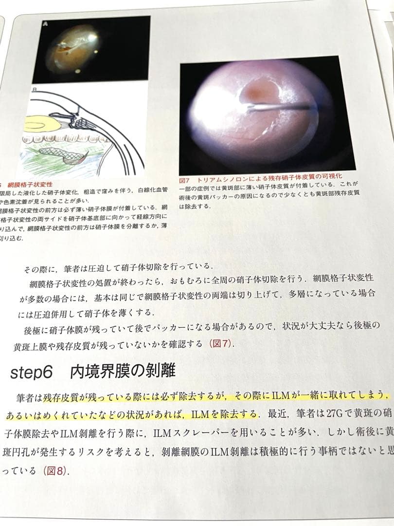 実況!硝子体手術Tips 165 【裁断済】❗️