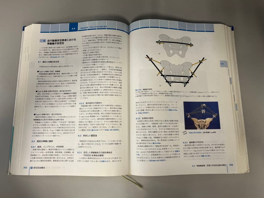 AO法 骨折治療