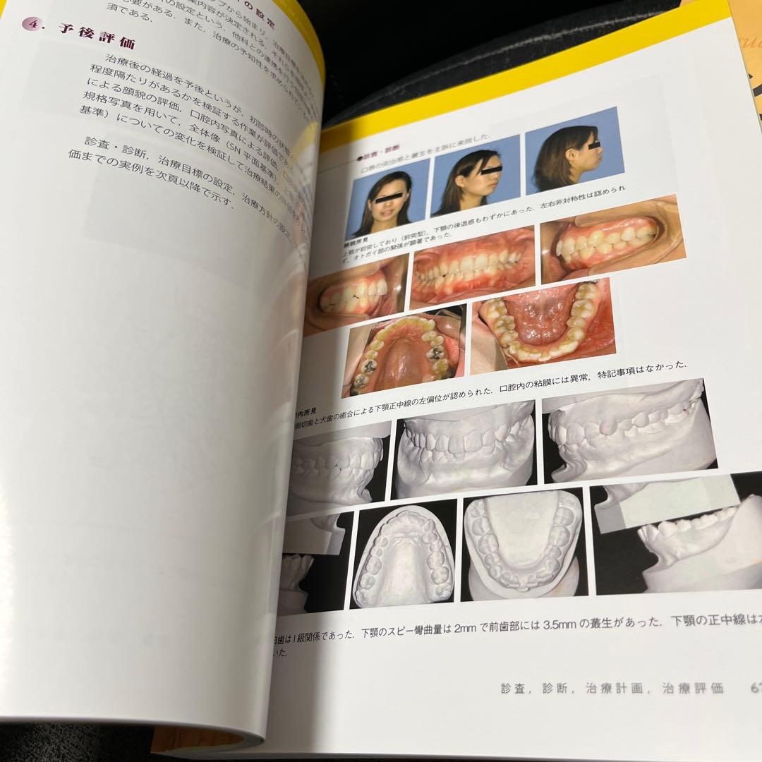 リンガルブラケット矯正法