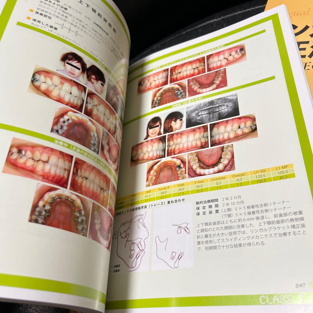 リンガルブラケット矯正法