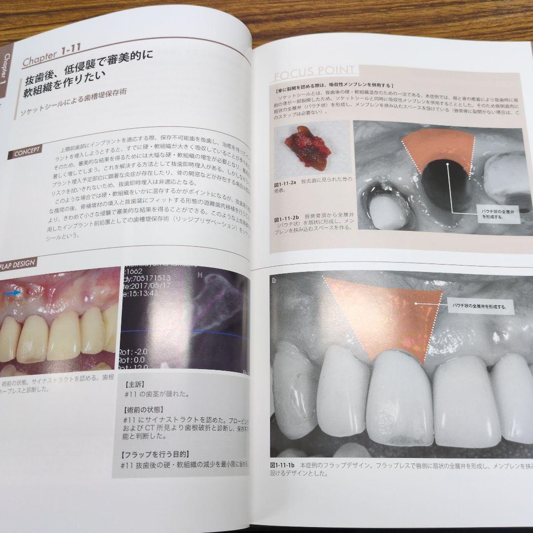 このシチュエーションにこの切開 フラップデザインアルバム