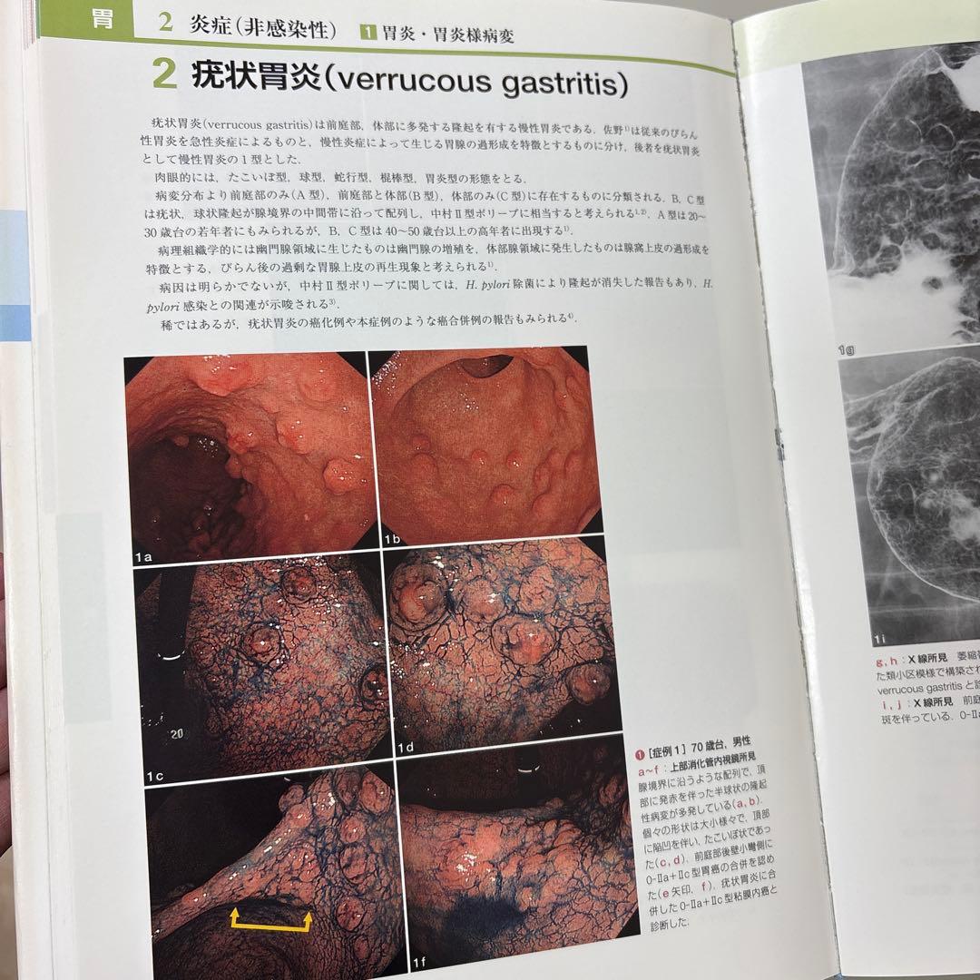参考書　胃と腸アトラスⅠ 上部消化管、II 下部消化管 第2版