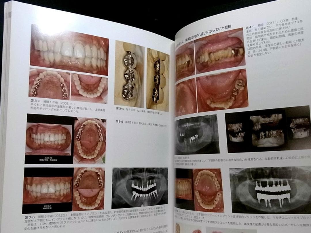 補綴臨床別冊 歯列を守る力のマネジメント 力を診る