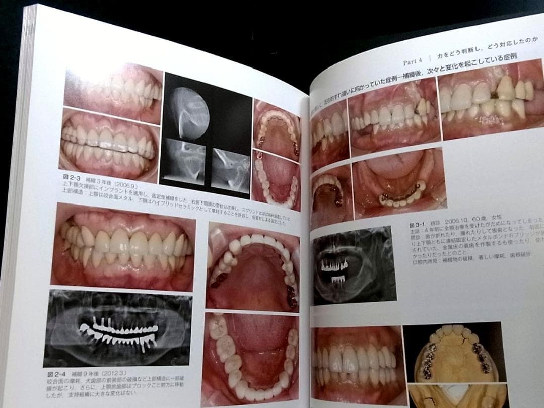 補綴臨床別冊 歯列を守る力のマネジメント 力を診る