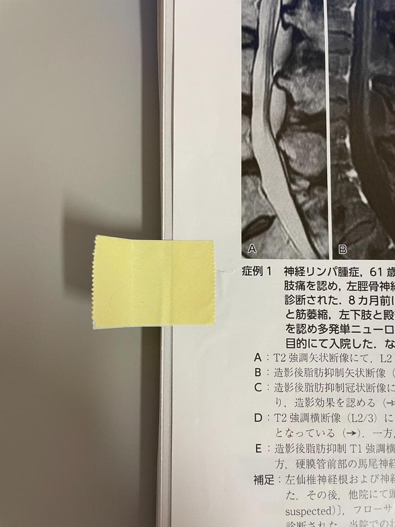 エキスパートのための脊椎脊髄疾患のMRI 第3版【裁断済】