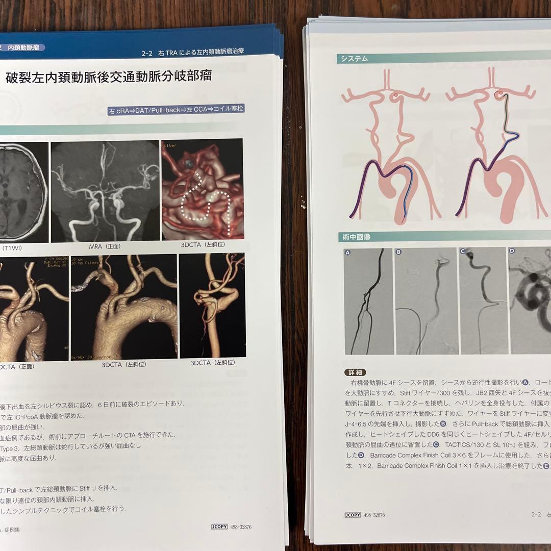 【裁断済み】脳血管内治療医のための経橈骨動脈治療テクニカルガイド