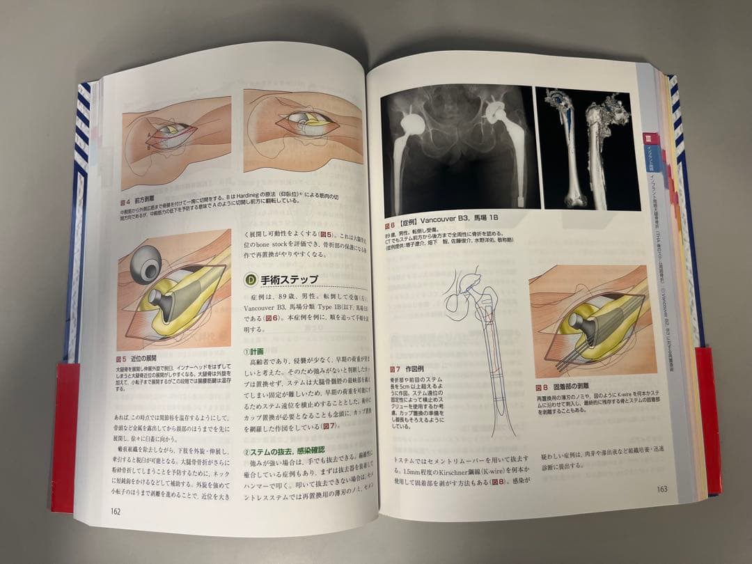 スタンダード 骨折手術治療 下肢