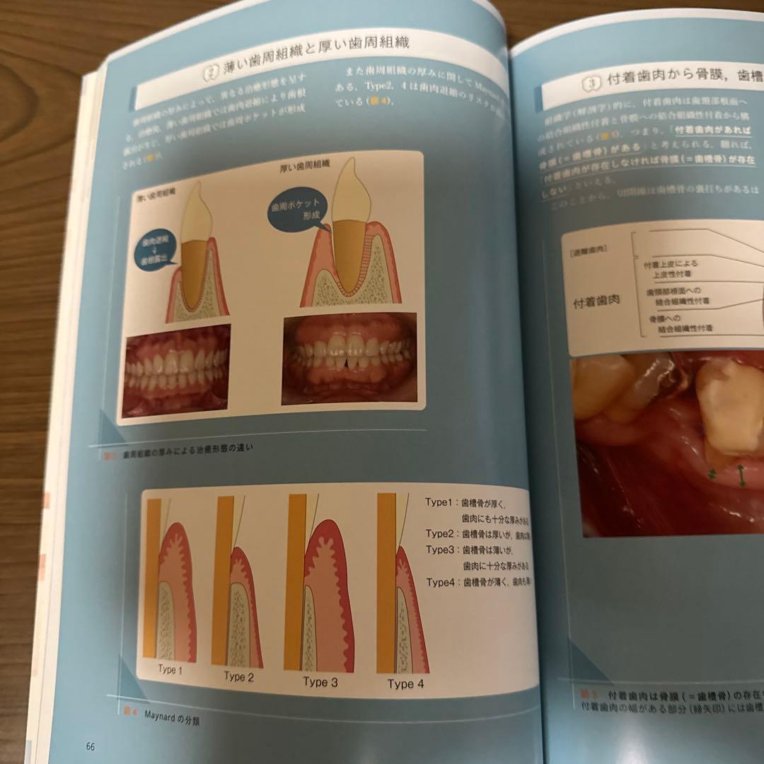 ペリオの治療形態と治し方